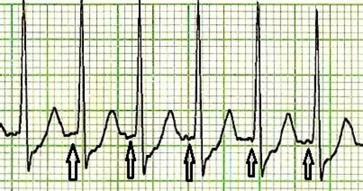 Does SVT have P waves