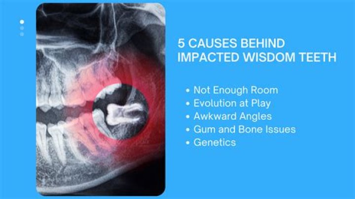 Who does surgery on wisdom teeth